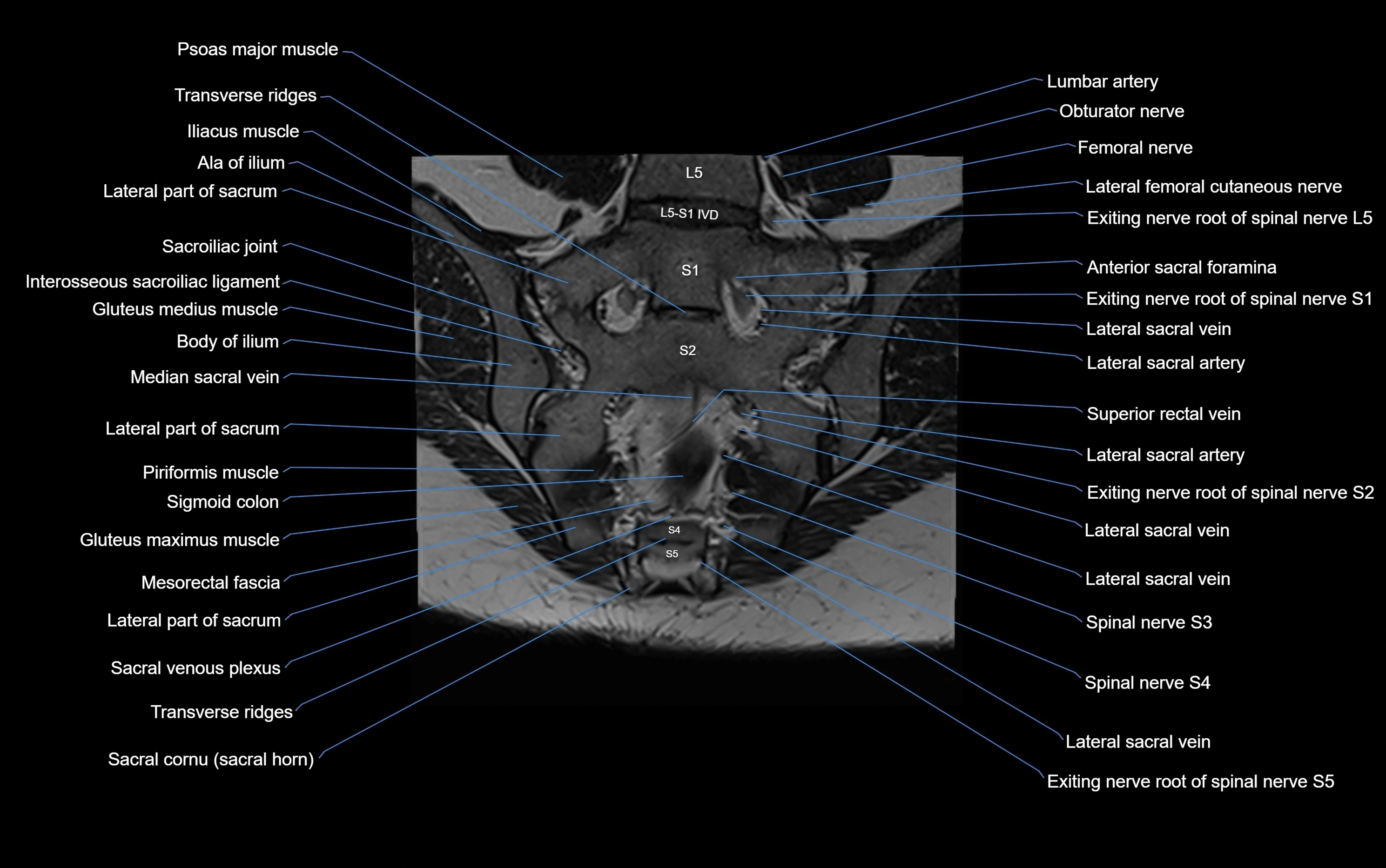 MRI sacroiliac joint coronal cross sectional anatomy  radiology  image-img-00001-00019.webp